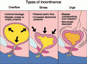 tipovi inkontinencije žene